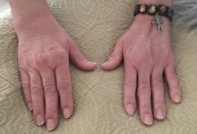 This Woman Put Her Rheumatoid Arthritis Into Remission Thanks To One Lifestyle Change